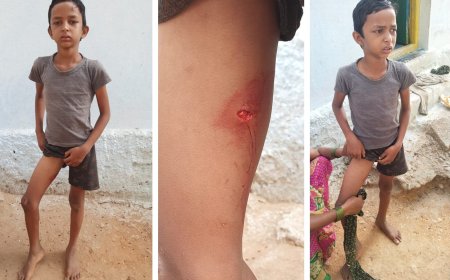 వీధికుక్కల దాడిలో చిన్నారి బాలుడికి తీవ్ర గాయాలు