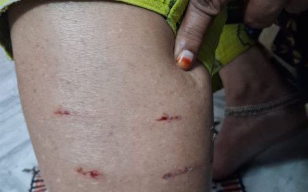 కుక్క కాటుతో మహిళకు గాయాలు