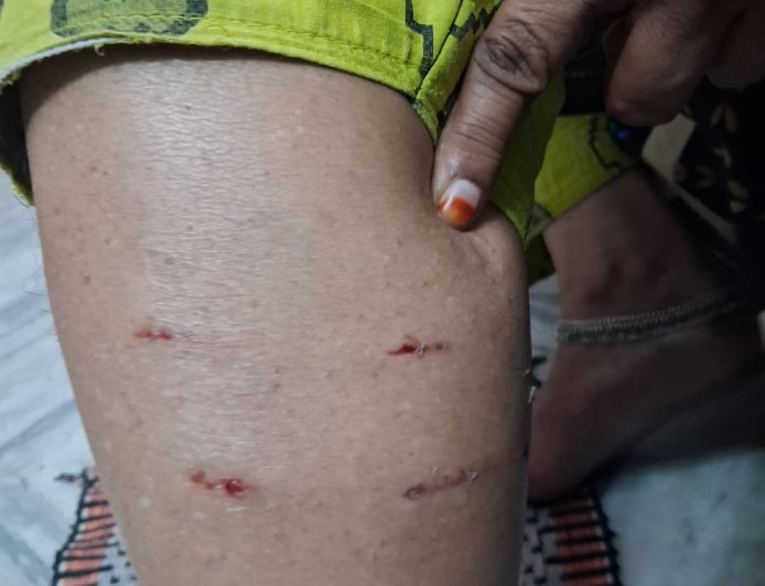 కుక్క కాటుతో మహిళకు గాయాలు