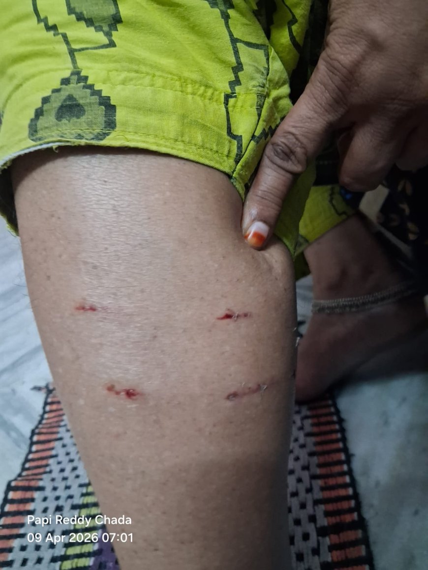 కుక్క కాటుతో మహిళకు గాయాలు